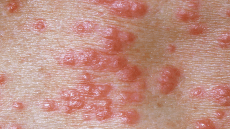 Std Rash Which Stds Cause Rashes 